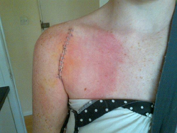 Following surgery on her shoulder.